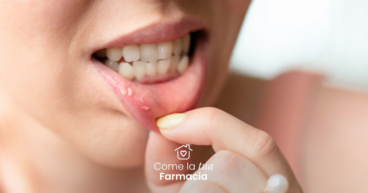 Afte in bocca? Ecco cosa fare
